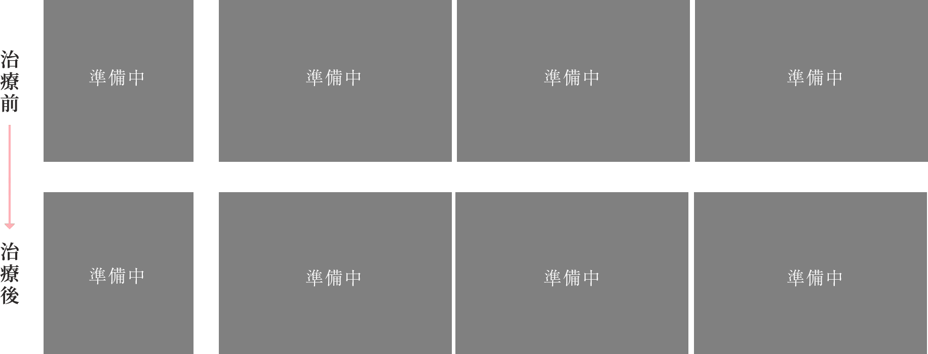 空隙歯列(すきっ歯)