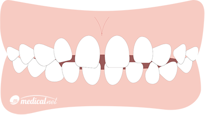 空隙歯列／すきっ歯