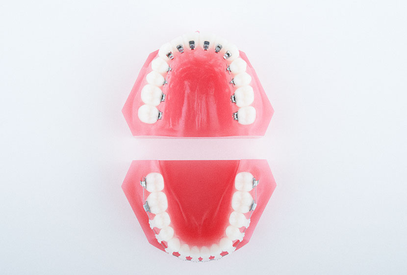 見えやすい上の歯だけを舌側（裏側）の装置で矯正する裏側矯正『ハーフリンガル』